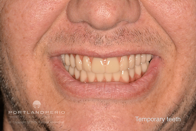 Patient of Portland Perio Implant Center with temporary "same day" teeth for all on 4 dental implant treatment.