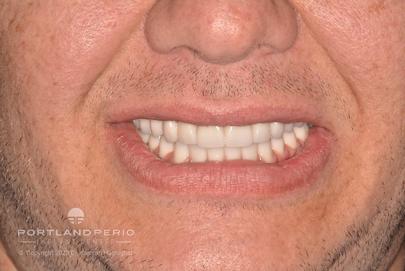 All On 4 Dental Implants for Paul - Portland Perio Implant Center - Portland, OR