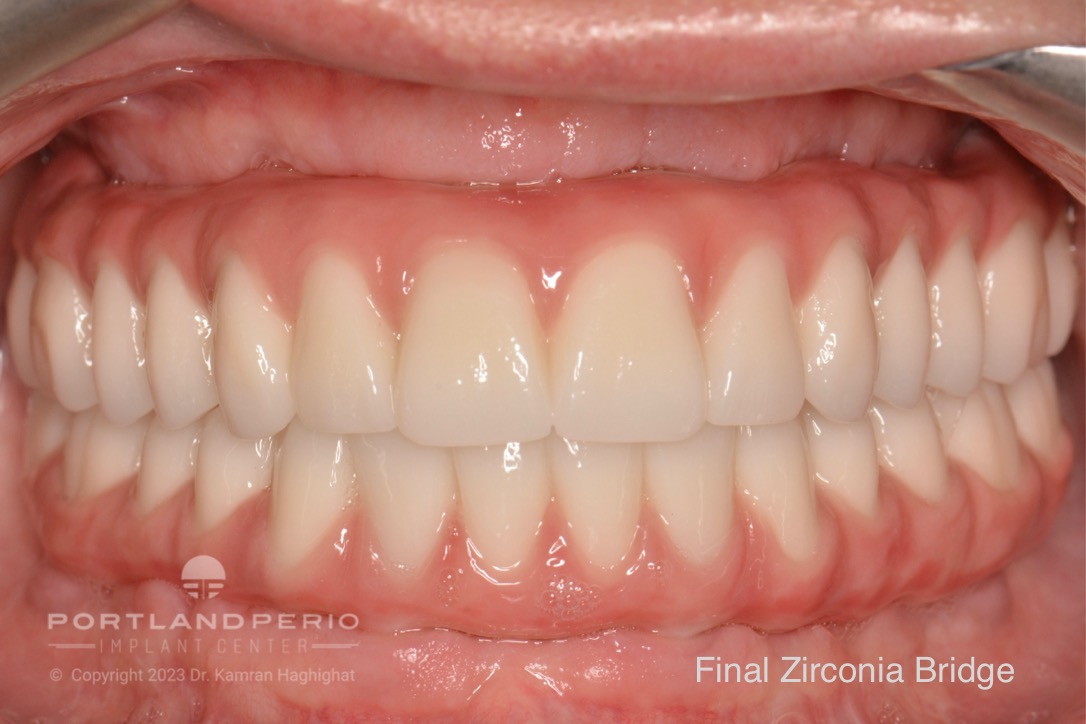 Final Zirconia bridge for patient receiving all on 4 dental implant treatment.
