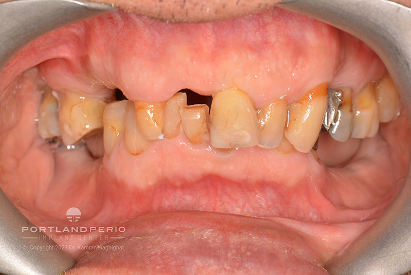 Double All On 4 Dental Implants Case Study for A.M. - Portland Perio Implant Center - Portland, OR - Dr. Kamran Haghighat