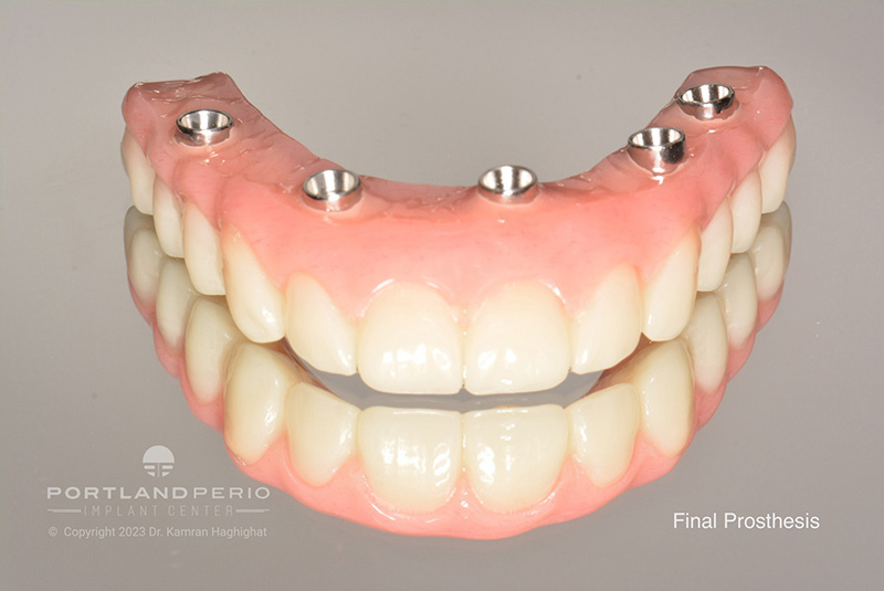 Double All On 4 Dental Implants Case Study for A.M. - Portland Perio Implant Center - Portland, OR - Dr. Kamran Haghighat