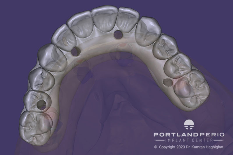 CAD CAM design of all on 4 bridges for patient at Portland Perio Implant Center.