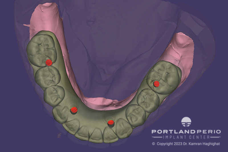 CAD CAM design of all on 4 bridges for patient at Portland Perio Implant Center.