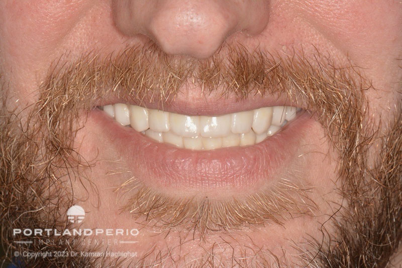 Zirconia bridges for all on 4 dental implant patient at Portland Perio Implant Center