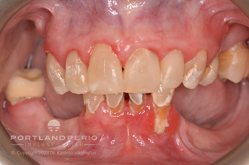 Before photo of all on 4 dental implants at Portland Perio Implant Center