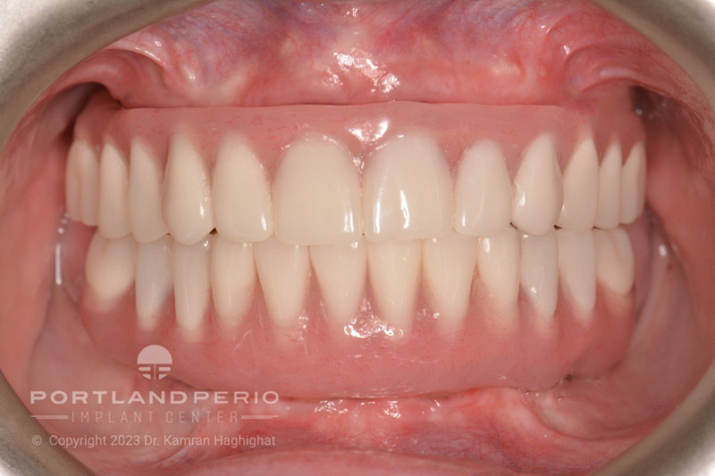 Patient of Portland Perio Implant Center after all on 4 dental implant treatment.