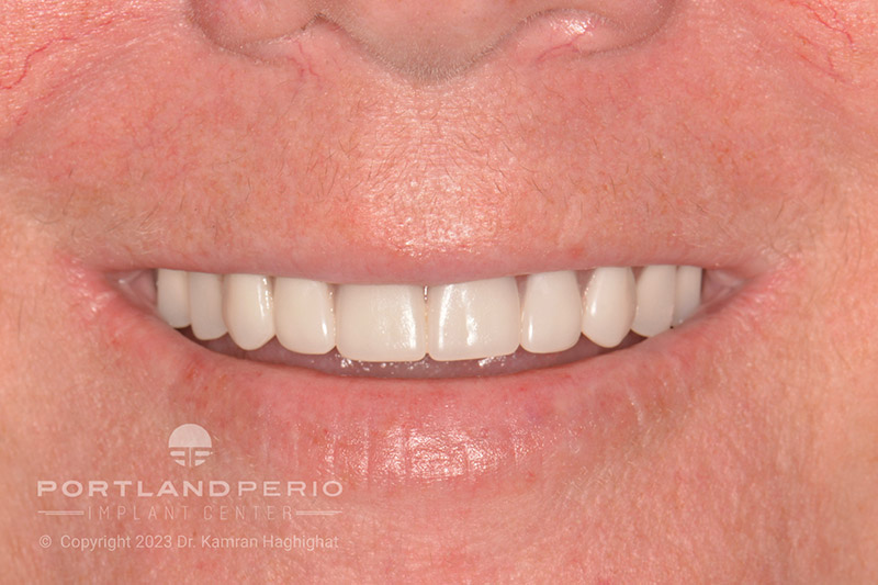 Patient of Portland Perio Implant Center after all on 4 dental implant treatment.