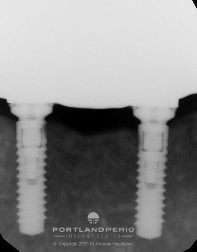 Radiographs for all on 4 dental implant patient of Portland Perio Impland Center of Portland.