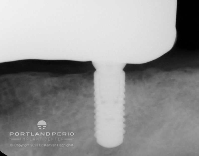 Radiographs for all on 4 dental implant patient of Portland Perio Impland Center of Portland.