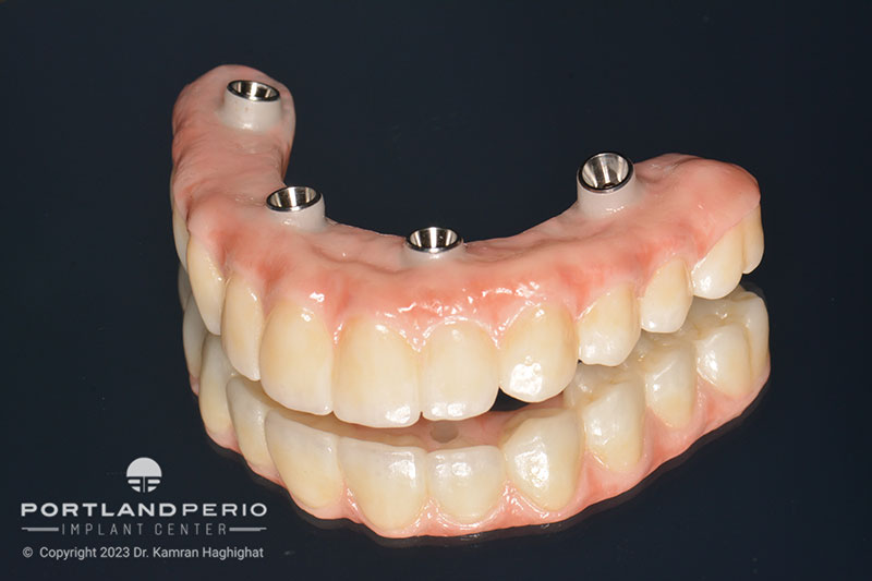 Upper Zirconia bridge for all on 4 dental implant patient at Portland Perio Implant Center