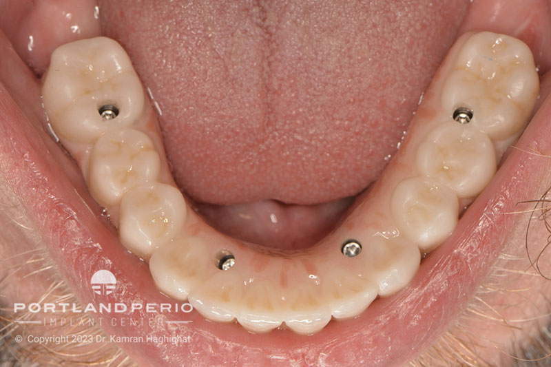 Lower Zirconia bridge for all on 4 dental implant patient at Portland Perio Implant Center