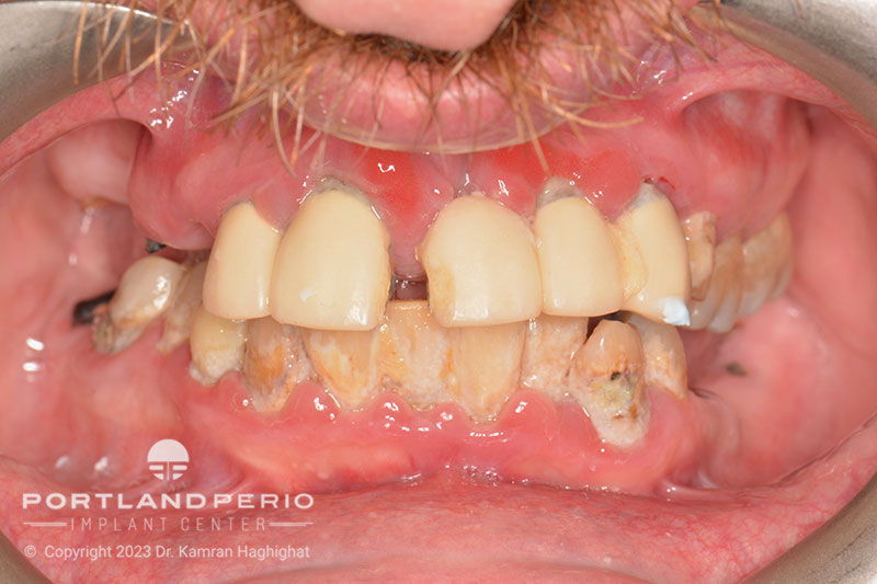 Patient of Portland Perio Implant Center before all-on-4 treatment