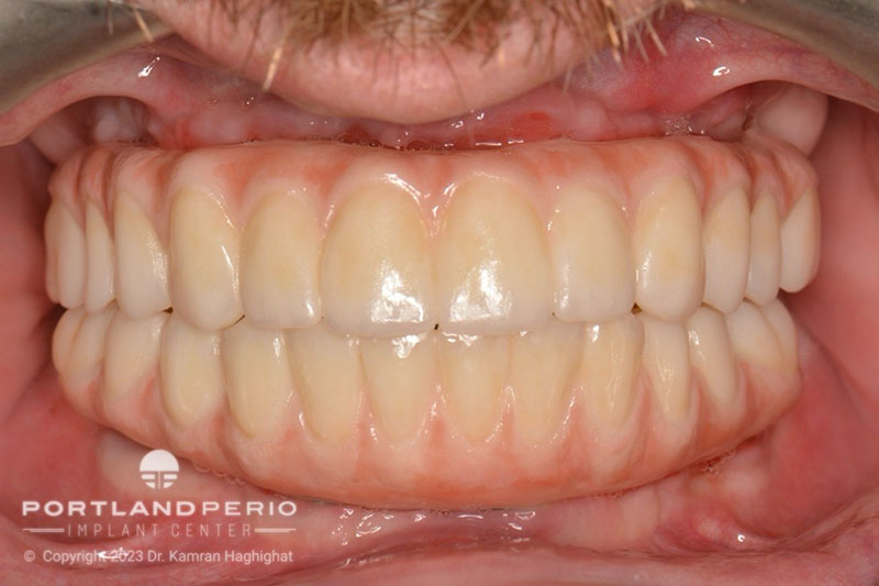 Upper and lower Zirconia bridge for all on 4 dental implant patient at Portland Perio Implant Center