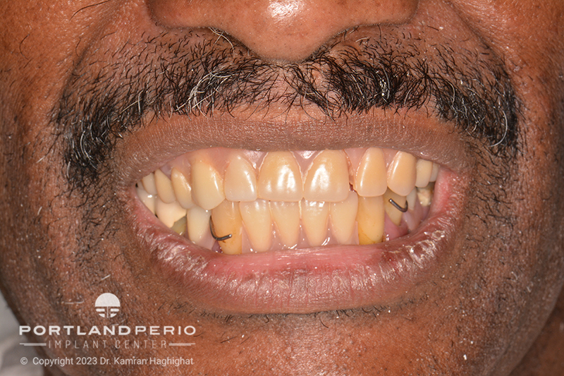 Patient needing dental treatment at Portland Perio Implant Center