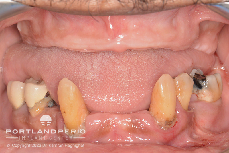 Close view of patient's mouth before dental treatment at Portland Perio Implant Center