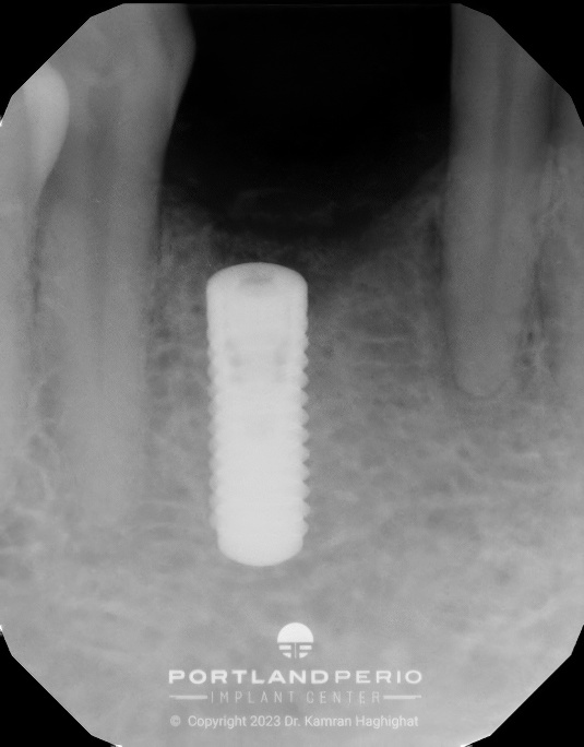 Portland-Perio-Implant-Center-xray-post