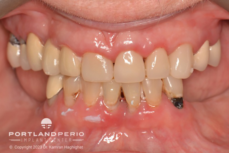 Patient before all-on-4 dental implant treatment at Portland Perio Implant Center