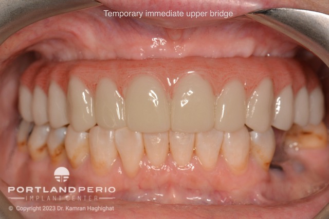 Temporary immediate upper bridge for dental implant patient at Portland Perio Implant Center