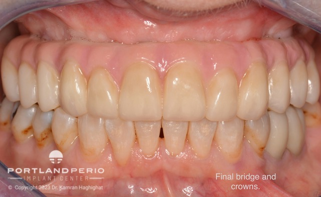 Final upper zirconia bridge and 2 lower crowns for patient at Portland Perio Implant Center