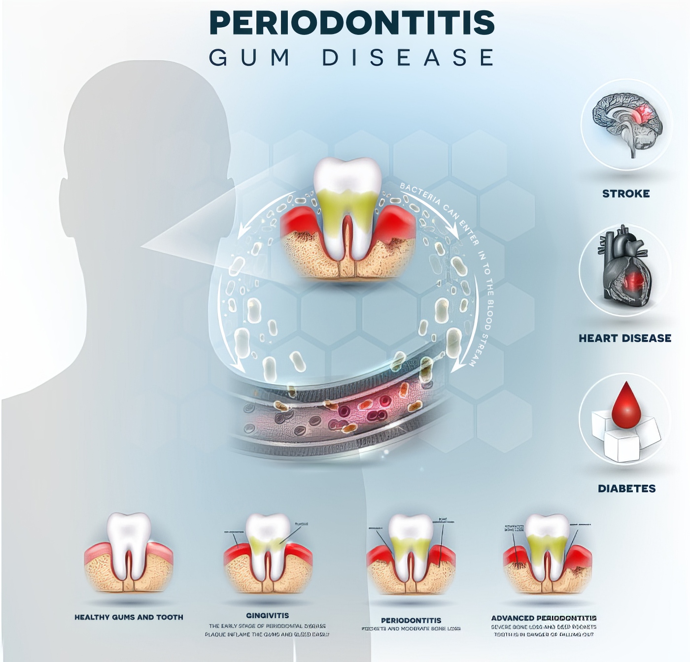 Stages of Periodontitis - Best Periodontist Portland