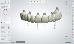 FP1 Prosthesis: A Bone Preserving Alternative To All On 4 Dental Implants - by Dr. Kamran Hagighat - Portland Perio Implant Center - Portland, OR