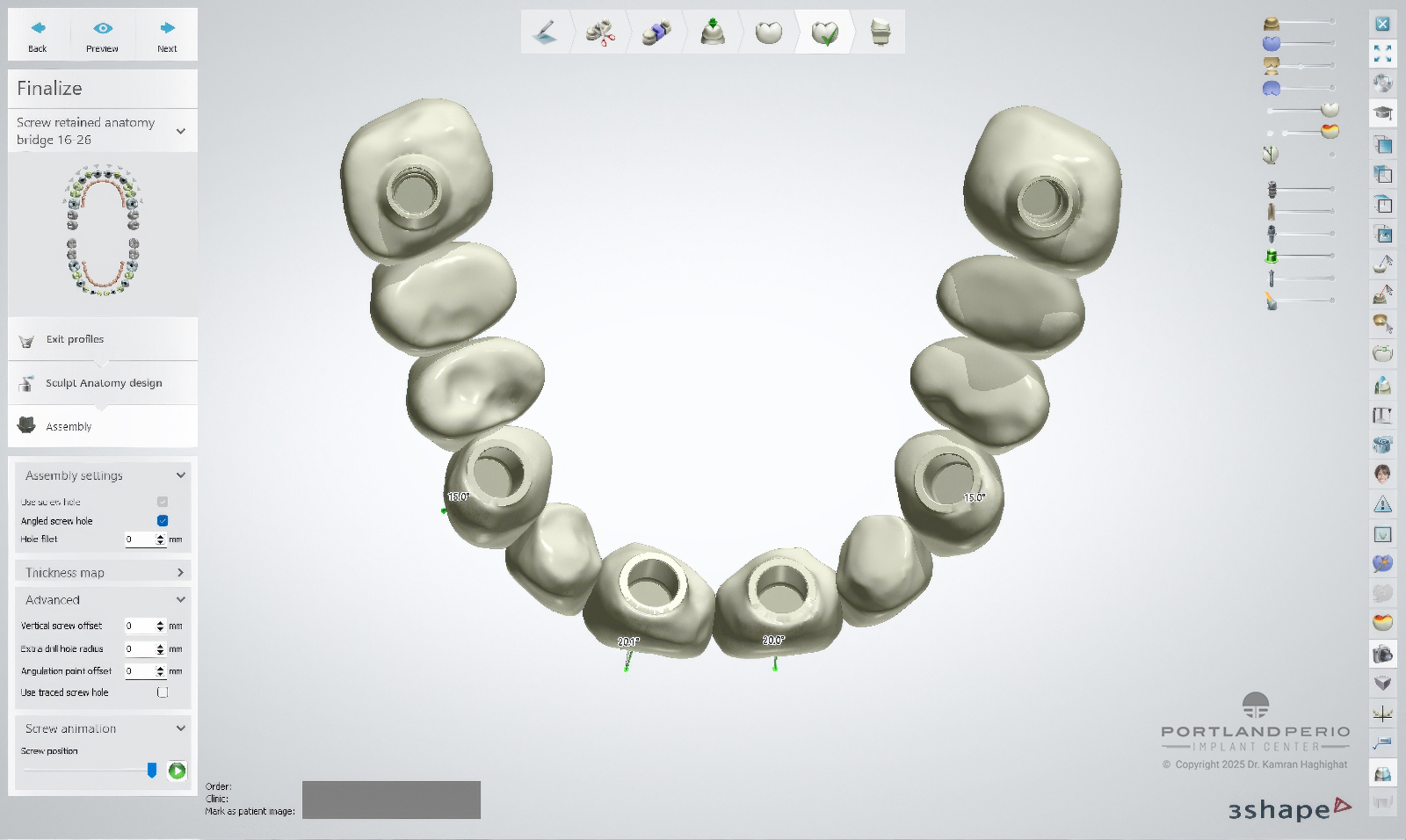 FP1 Prosthesis: A Bone Preserving Alternative To All On 4 Dental Implants - by Dr. Kamran Hagighat - Portland Perio Implant Center - Portland, OR