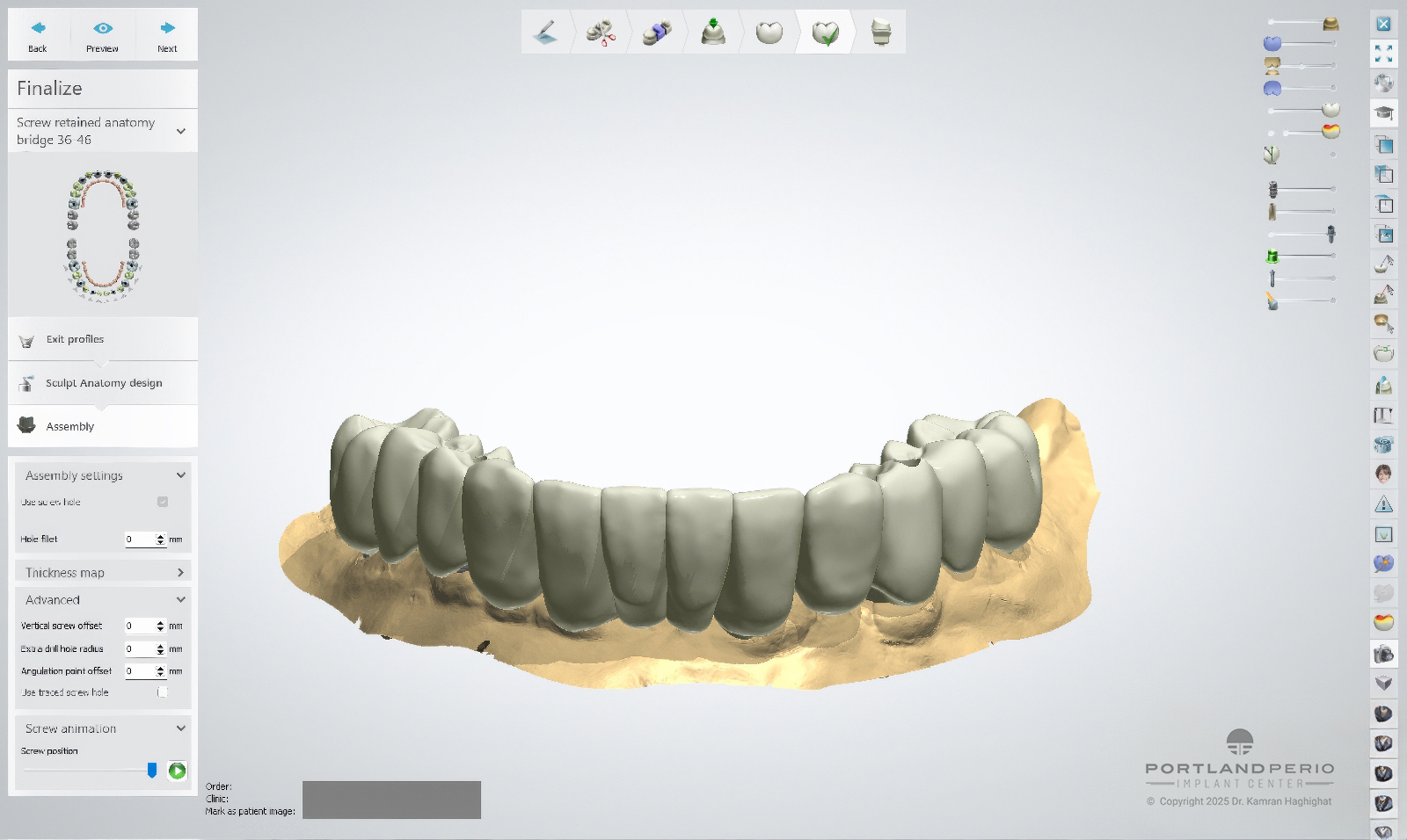 FP1 Prosthesis: A Bone Preserving Alternative To All On 4 Dental Implants - by Dr. Kamran Hagighat - Portland Perio Implant Center - Portland, OR
