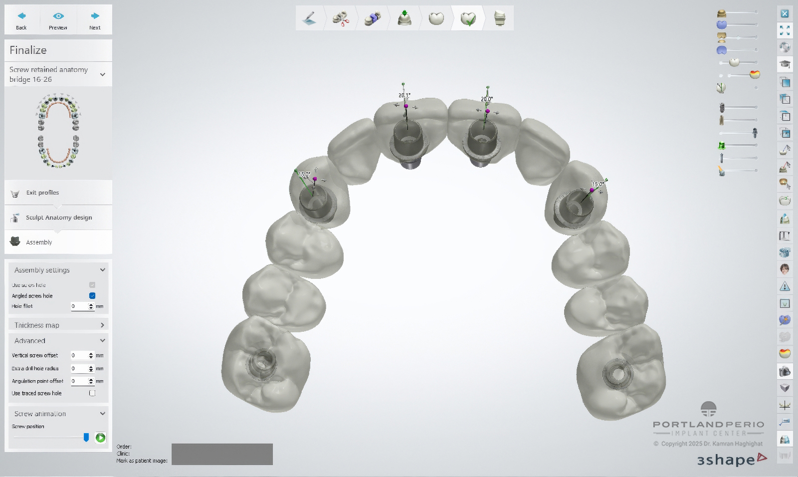 FP1 Prosthesis: A Bone Preserving Alternative To All On 4 Dental Implants - by Dr. Kamran Hagighat - Portland Perio Implant Center - Portland, OR