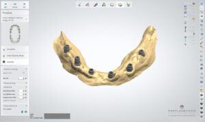 FP1 Prosthesis: A Bone Preserving Alternative To All On 4 Dental Implants - by Dr. Kamran Hagighat - Portland Perio Implant Center - Portland, OR