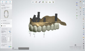 FP1 Prosthesis: A Bone Preserving Alternative To All On 4 Dental Implants - by Dr. Kamran Hagighat - Portland Perio Implant Center - Portland, OR