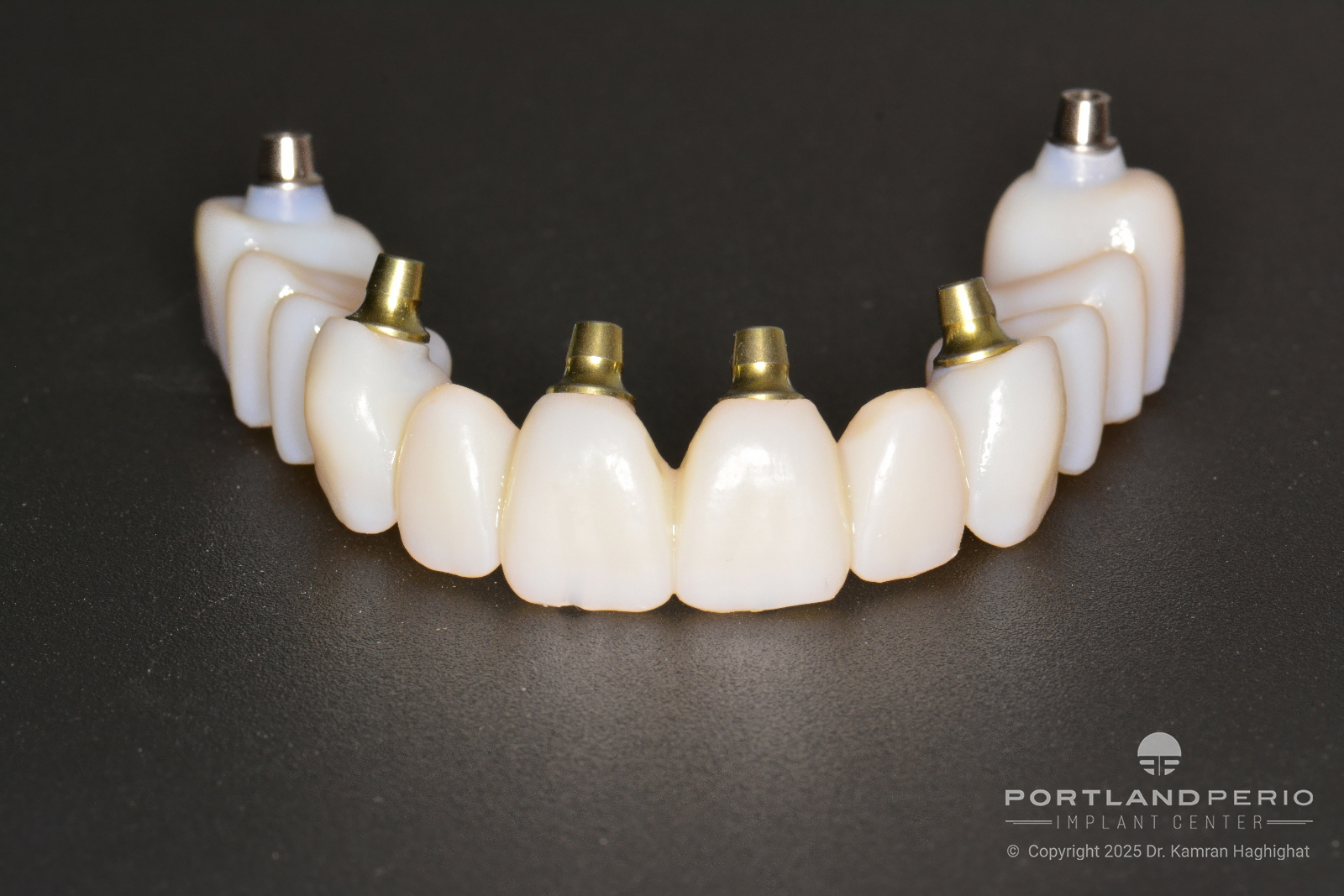 FP1 Prosthesis: A Bone Preserving Alternative To All On 4 Dental Implants - by Dr. Kamran Hagighat - Portland Perio Implant Center - Portland, OR