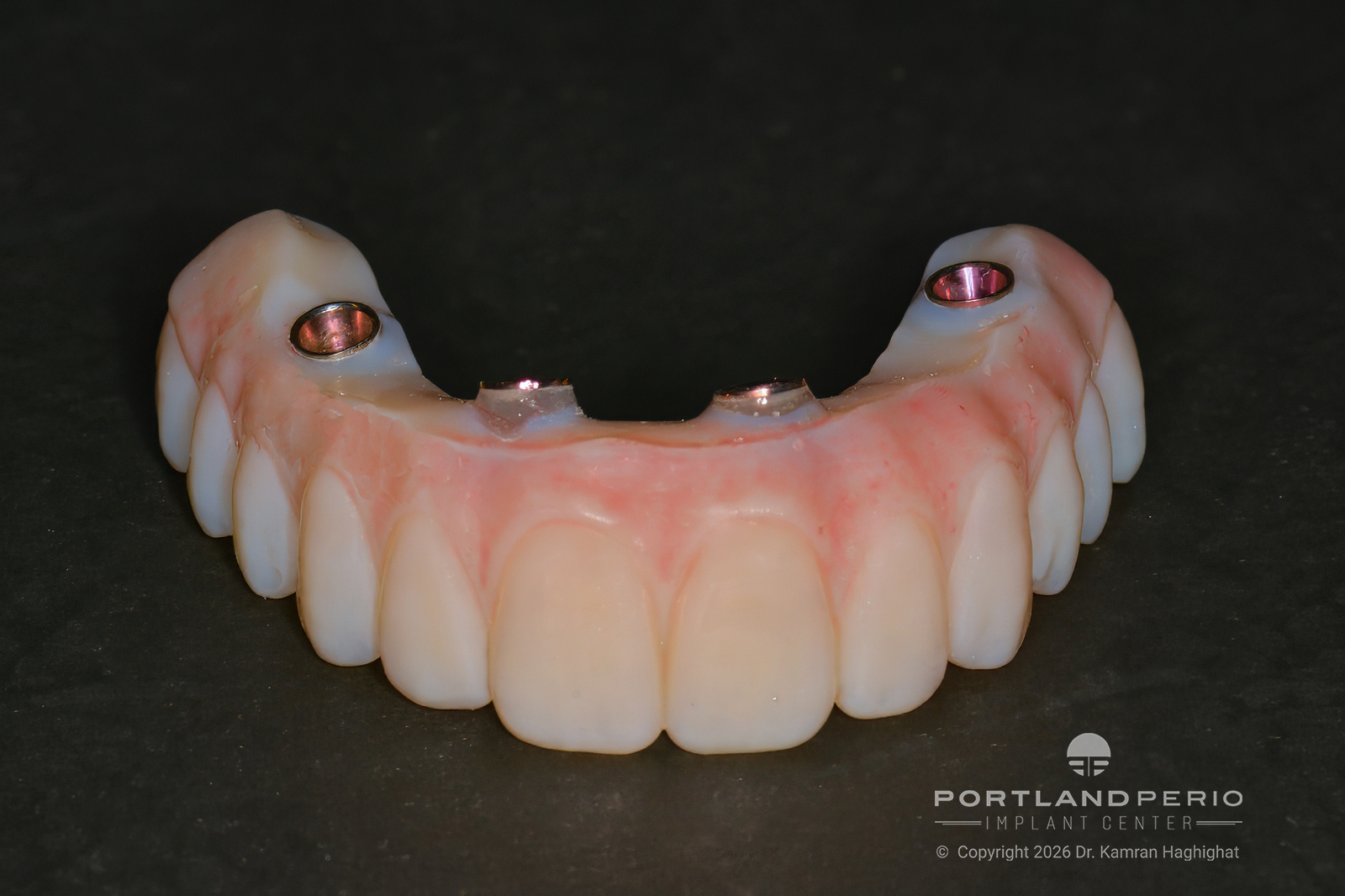 Double Arch All On 4 Rehabilitation with Zirconia and Titanium Framework Prosthesis - Portland Perio Implant Center - Dr. Kamran Haghighat
