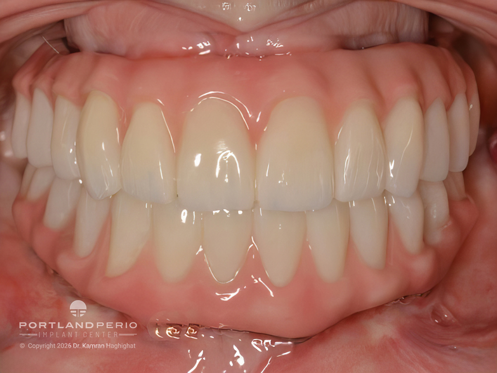 Double Arch All On 4 Rehabilitation with Zirconia and Titanium Framework Prosthesis - Portland Perio Implant Center - Dr. Kamran Haghighat