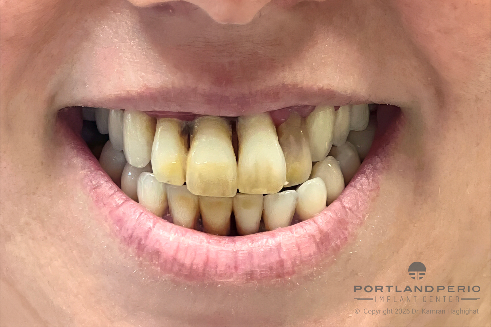 Double Arch All On 4 Rehabilitation with Zirconia and Titanium Framework Prosthesis - Portland Perio Implant Center - Dr. Kamran Haghighat