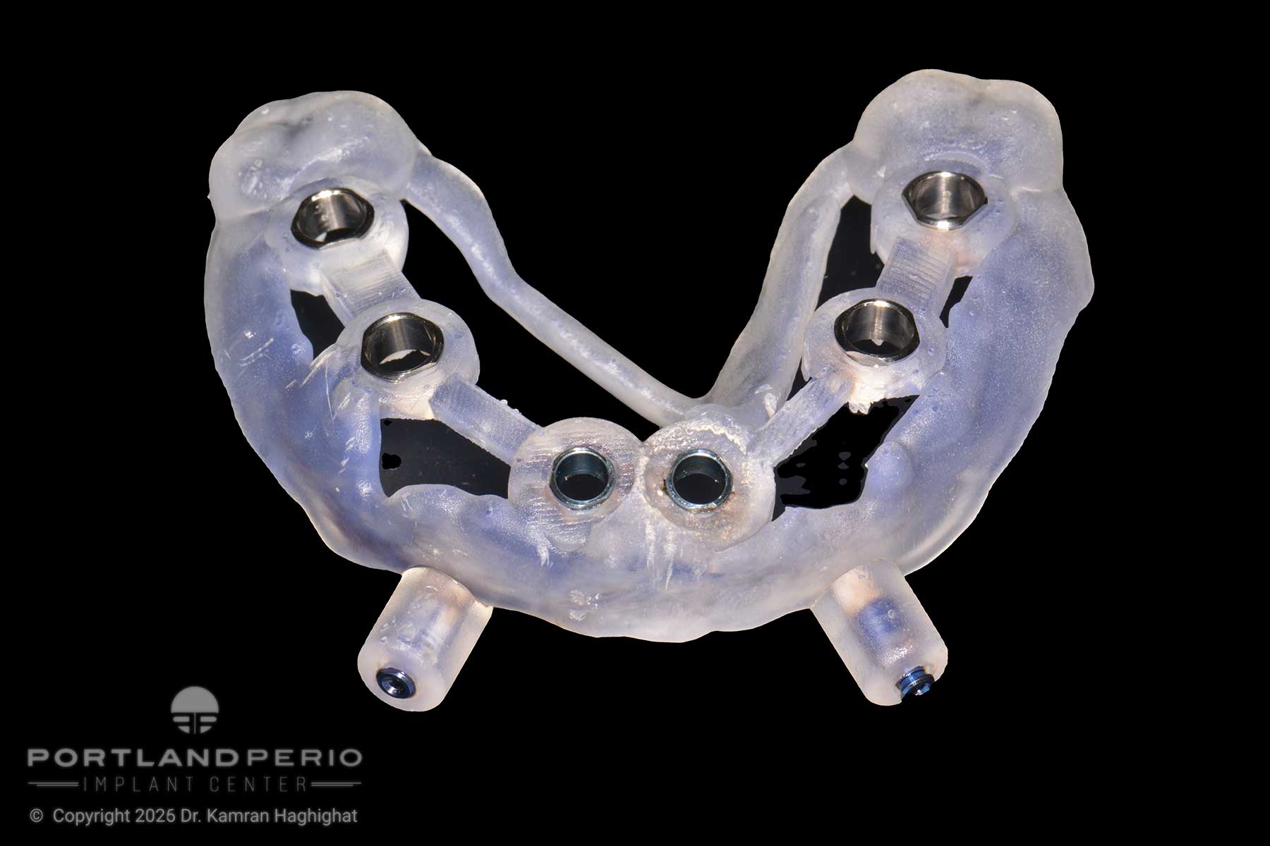 Upper jaw digital smile design showing implant placement for full arch dental rehabilitation with Dr. Kamran Haghighat