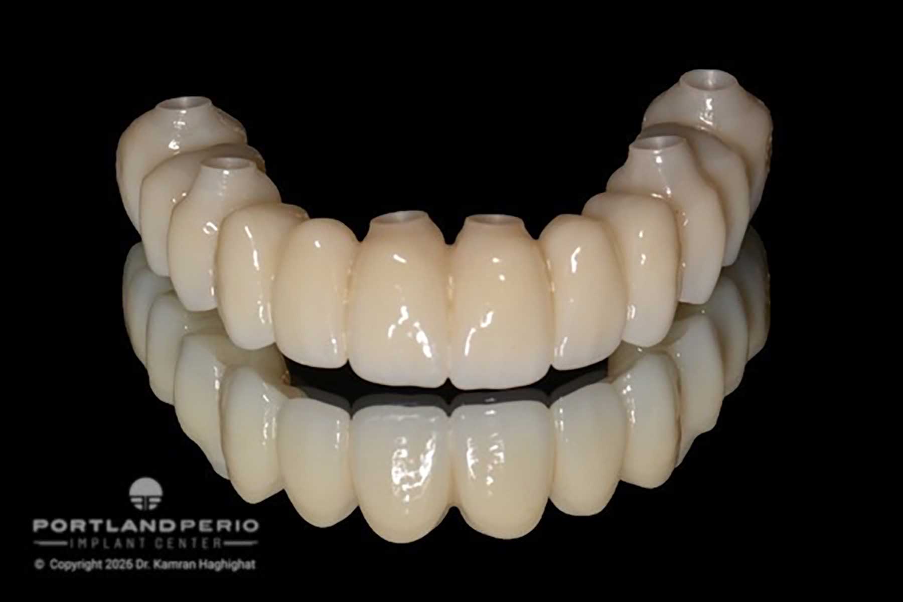 Full-arch dental rehabilitation prosthesis at Portland Perio Implant Center