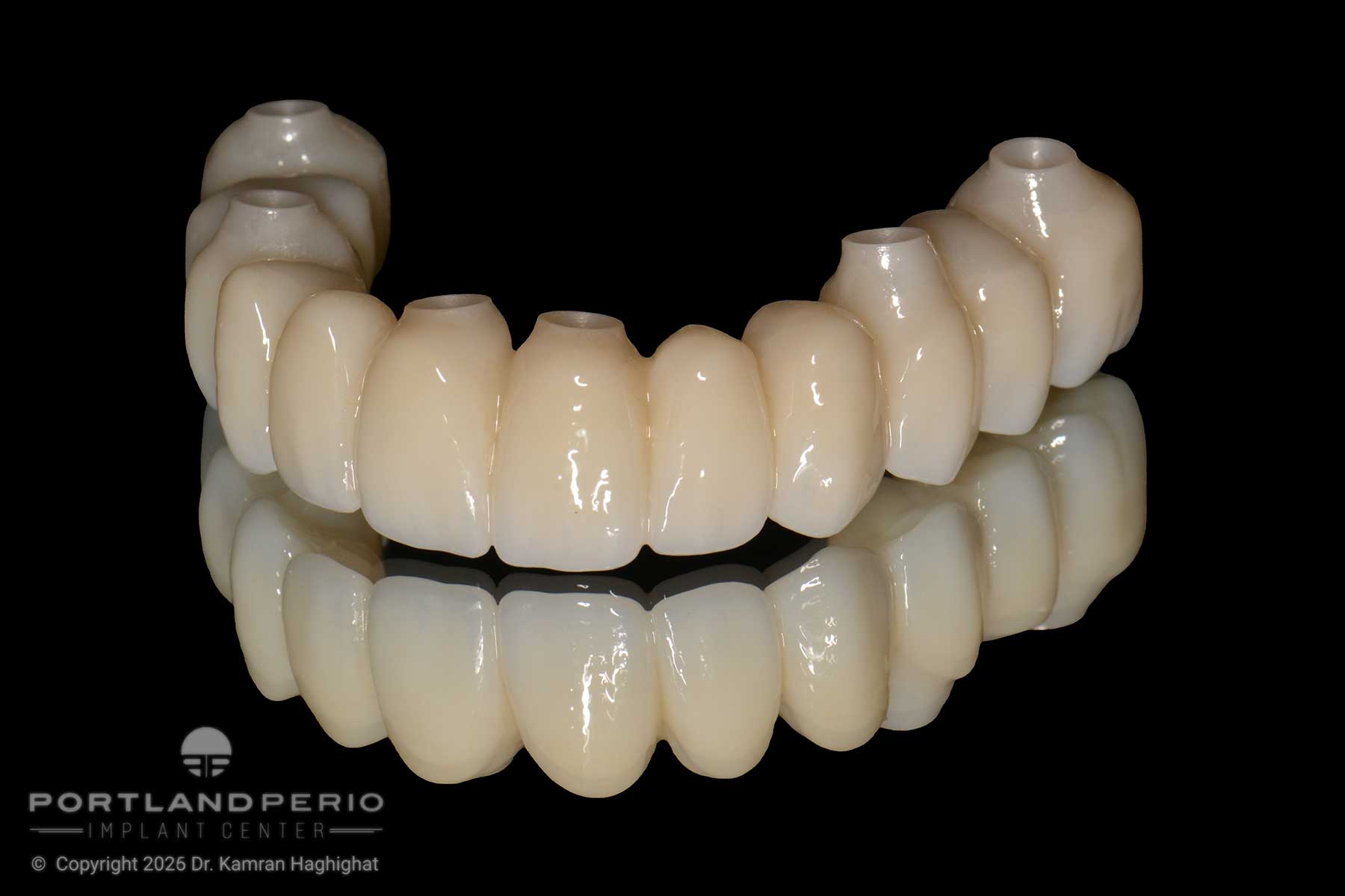 Full-arch dental rehabilitation prosthesis