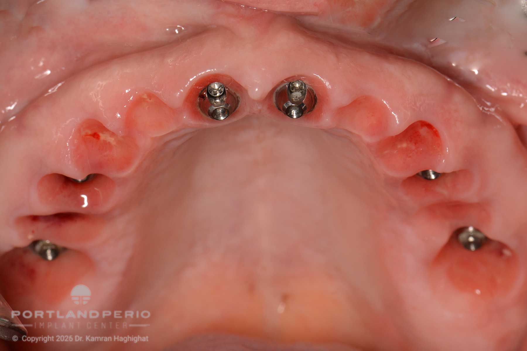 Upper jaw showing implant placement for full arch dental rehabilitation with Dr. Kamran Haghighat