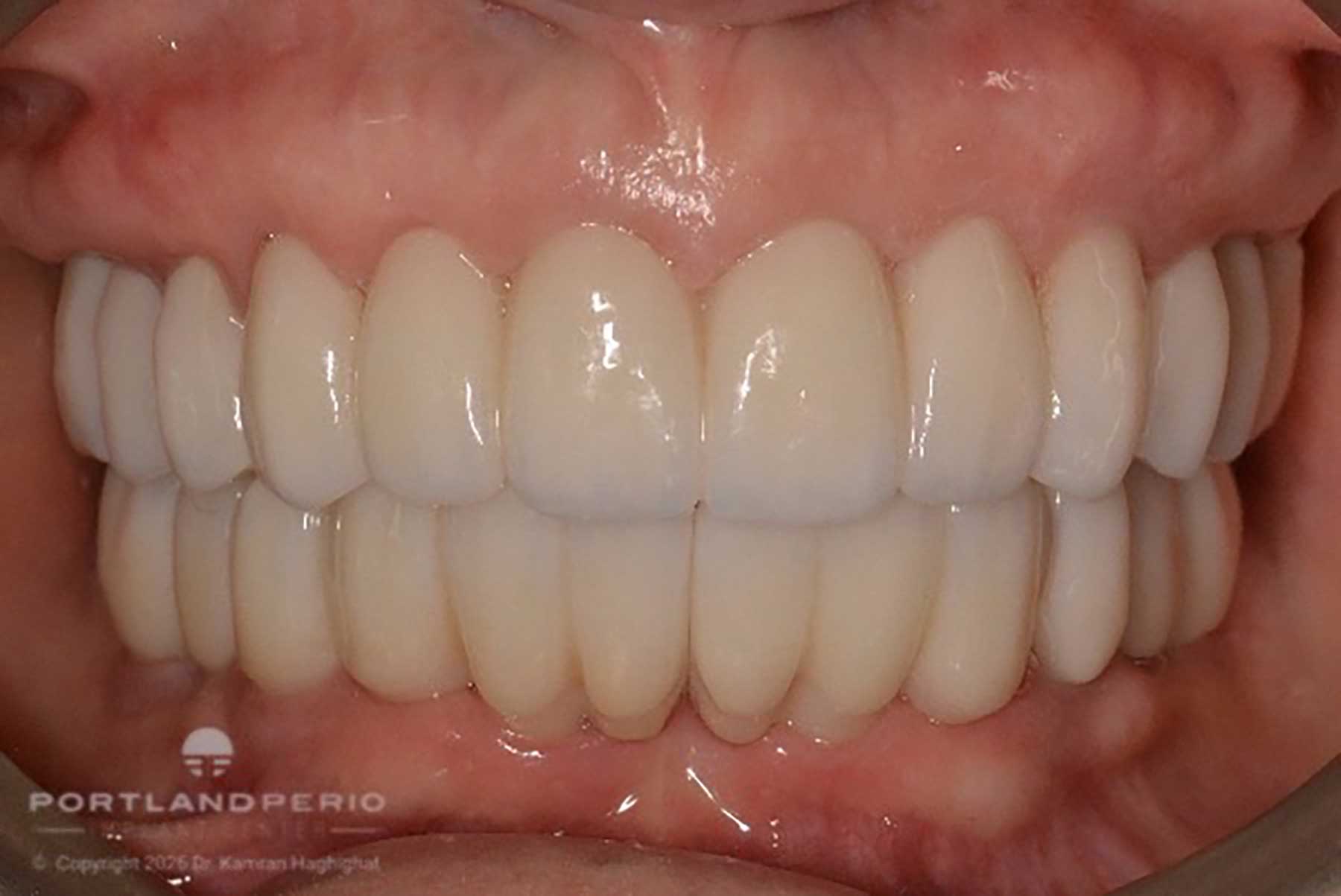 Full-arch dental rehabilitation prosthesis