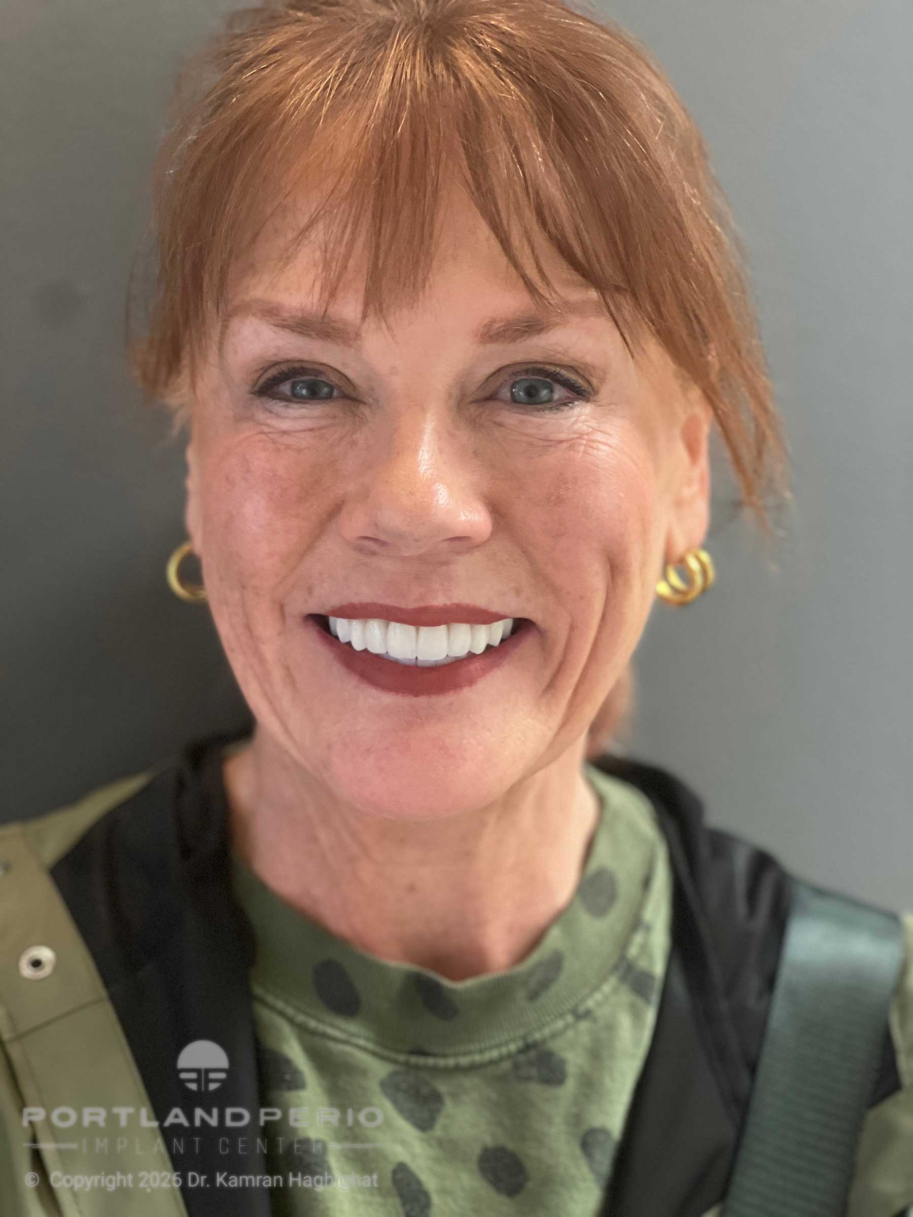 Full-arch dental rehabilitation patient after treatment