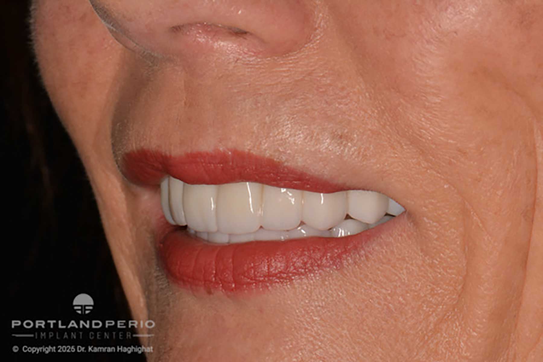 Full-arch dental rehabilitation patient after treatment