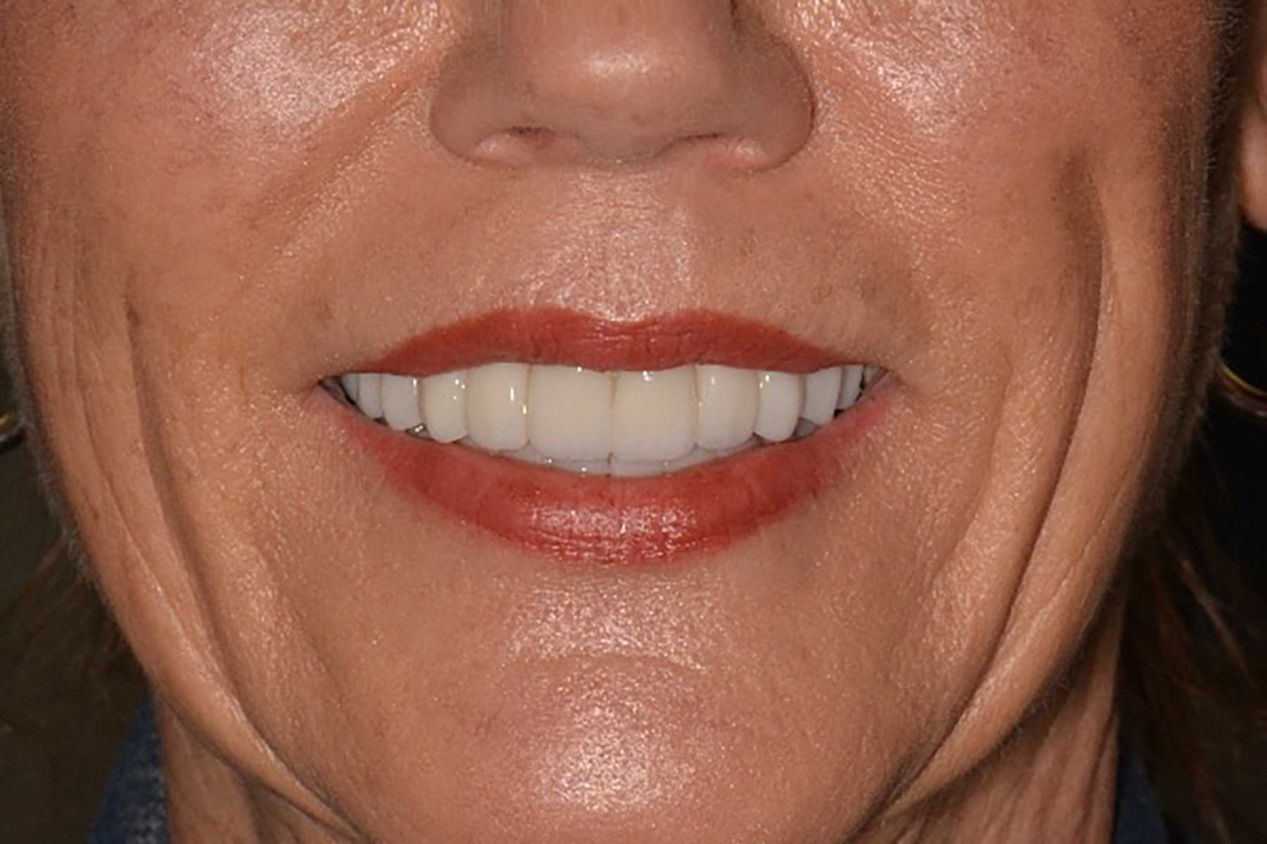 Full-arch dental rehabiliation patient