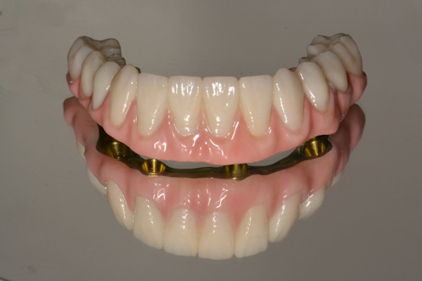 Double Arch All On 4 Rehabilitation with Zirconia and Titanium Framework Prosthesis - Portland Perio Implant Center - Dr. Kamran Haghighat
