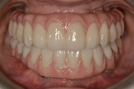 Double Arch All On 4 Rehabilitation with Zirconia and Titanium Framework Prosthesis - Portland Perio Implant Center - Dr. Kamran Haghighat