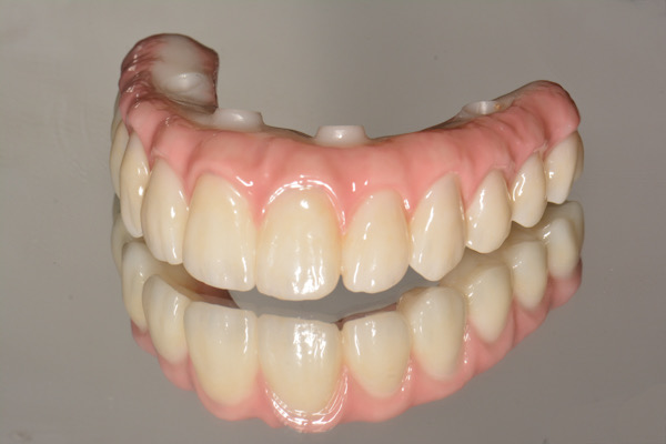 Double Arch All On 4 Rehabilitation with Zirconia and Titanium Framework Prosthesis - Portland Perio Implant Center - Dr. Kamran Haghighat