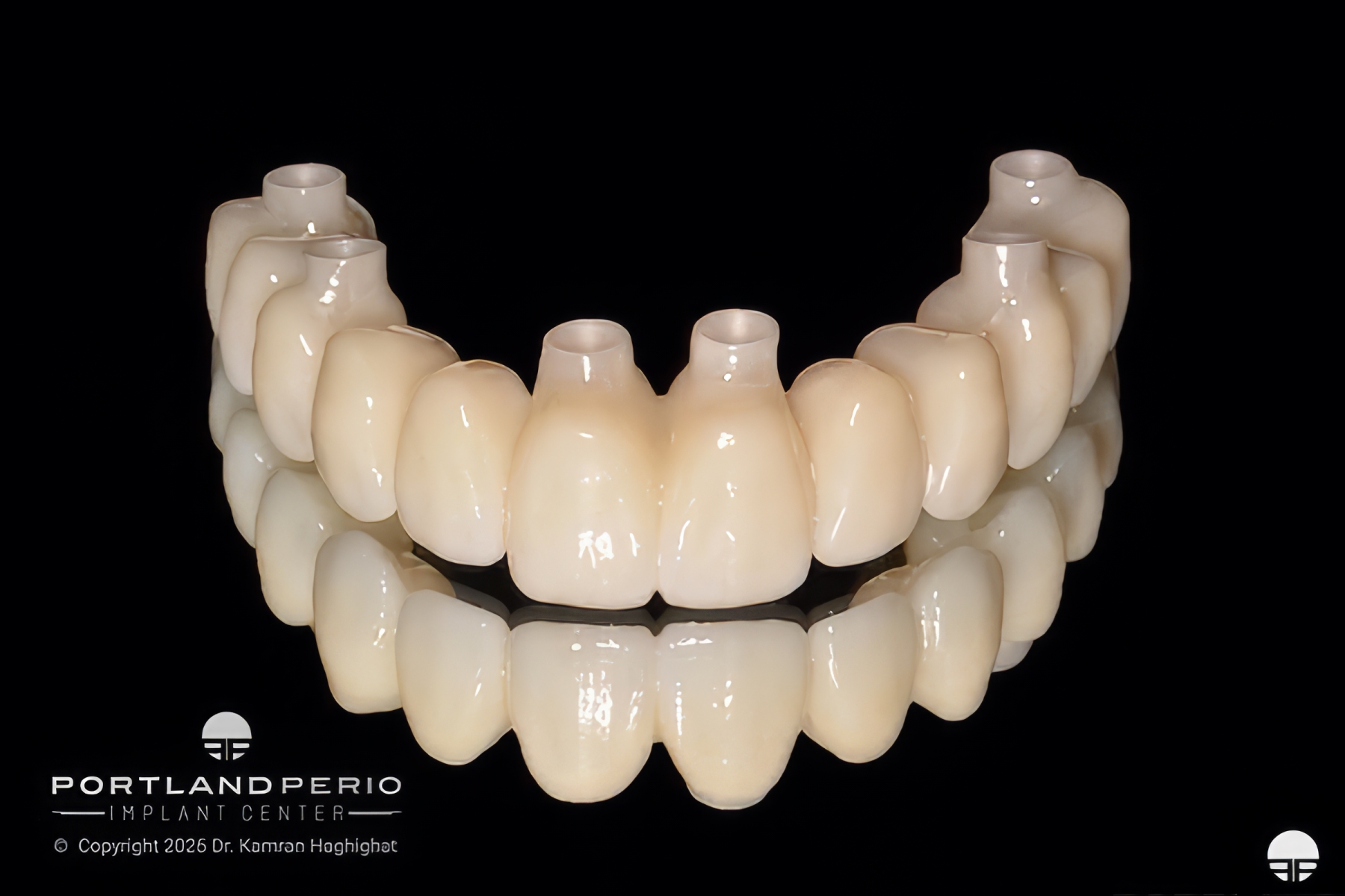 Final upper zirconia prosthesis