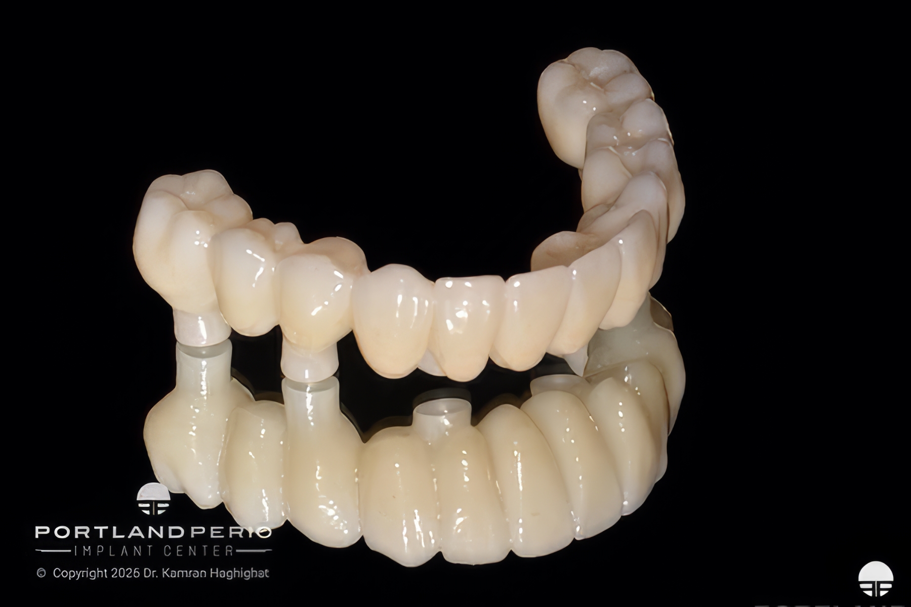 Final lower zirconia prosthesis
