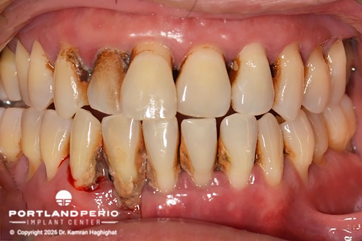 Full-arch rebilitation with all-on-x, utiizing an FP1 prosthetic design - Portland Perio Implant Center - Dr. Kamran Haghighat