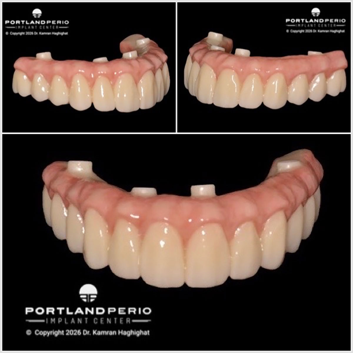 Upper jaw digital smile design showing implant placement for full arch dental rehabilitation with Dr. Kamran Haghighat