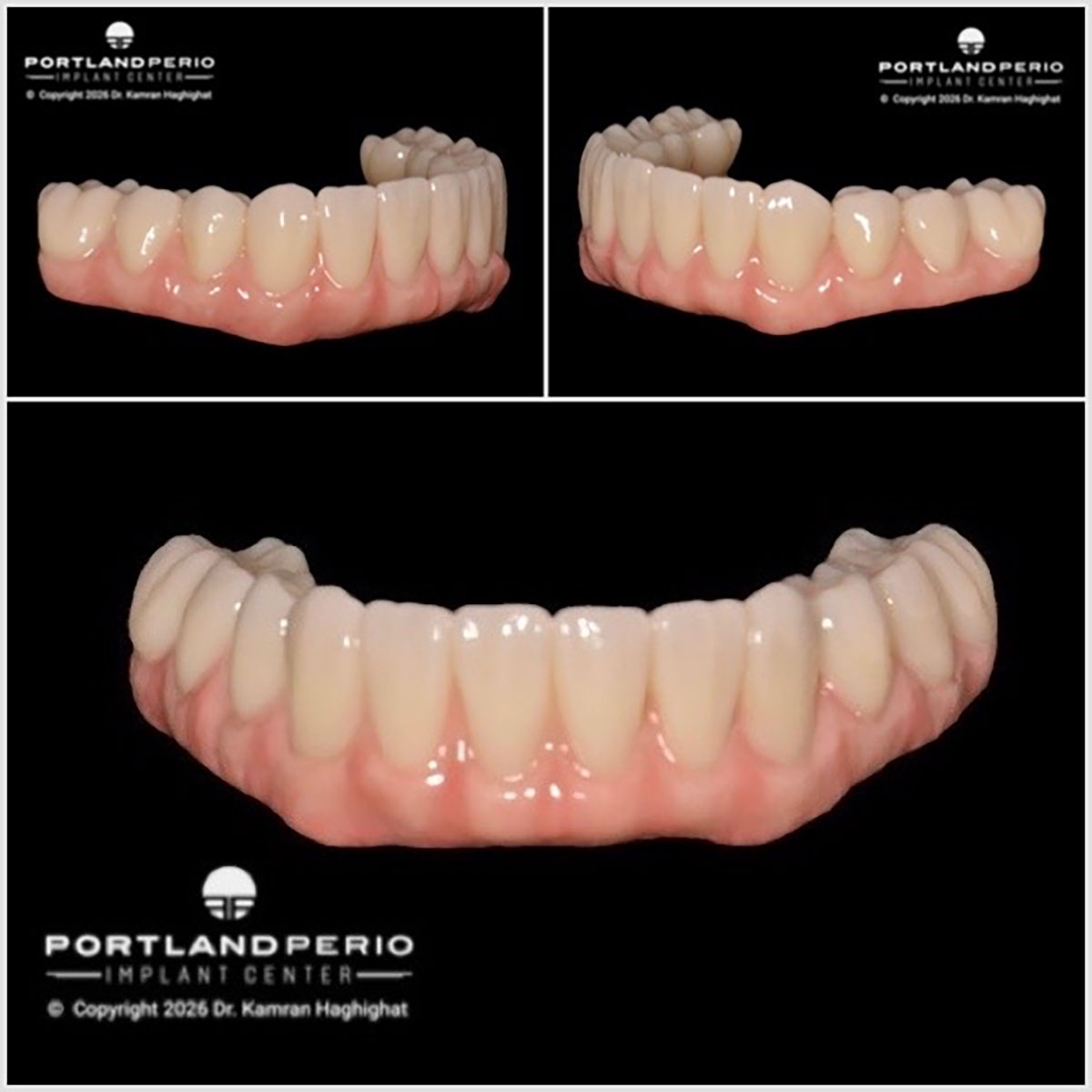 Lower jaw digital smile design showing implant placement for full arch dental rehabilitation with Dr. Kamran Haghighat